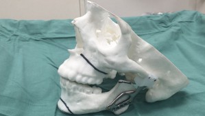 Пациент получил челюсть, напечатанную на 3D-принтере